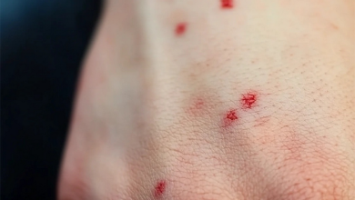 A close-up of a hand showing red spots, with healthcare tips for treatment and prevention in the background