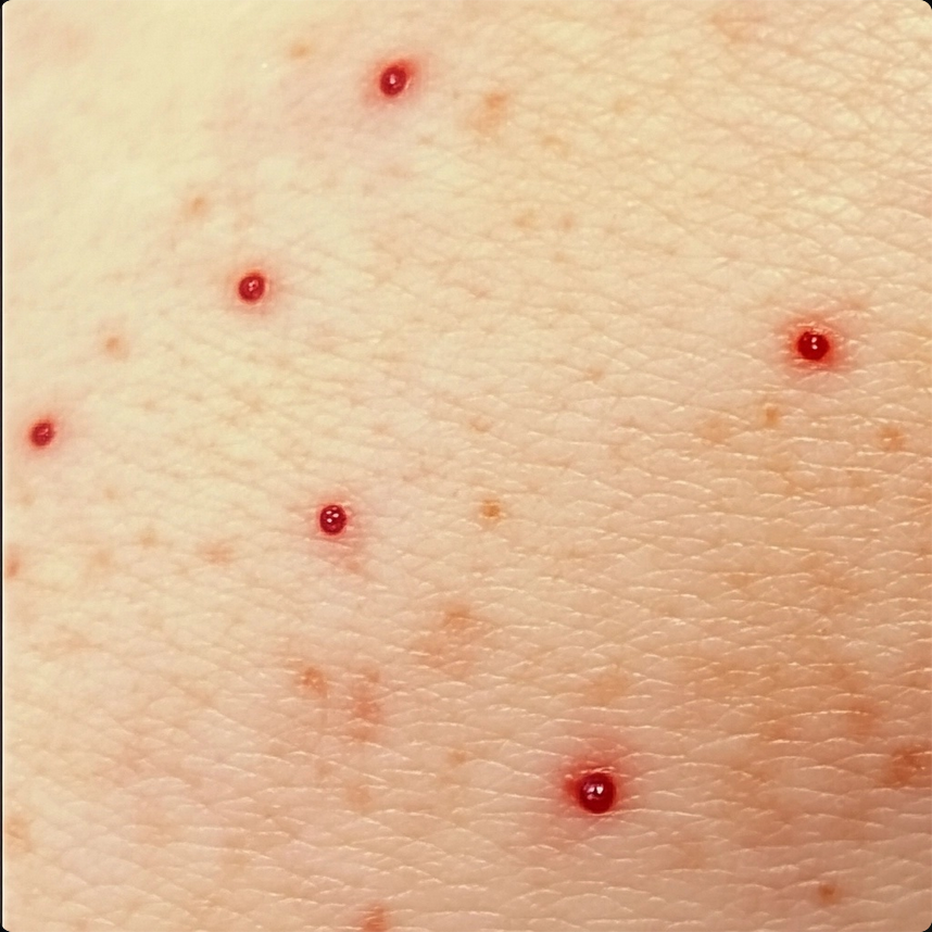 The image shows small, red spots scattered on light-colored skin. These marks vary slightly in size, are raised in some areas, and grouped closely. The top section highlights 4-5 distinct red dots arranged in a line or random pattern, and they appear vibrant and well-defined, suggesting they 