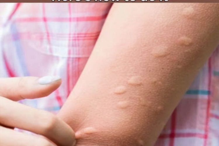 My Nana’s Mosquito Bite Trick – Soothe Those Itches in 2 Minutes!